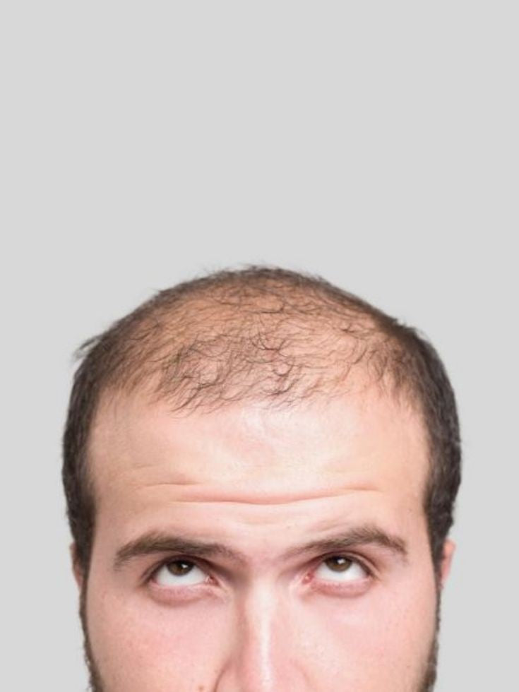 Minoxidil solución al 5%IPKY tratamiento para la calvicie y pérdida de cabello 