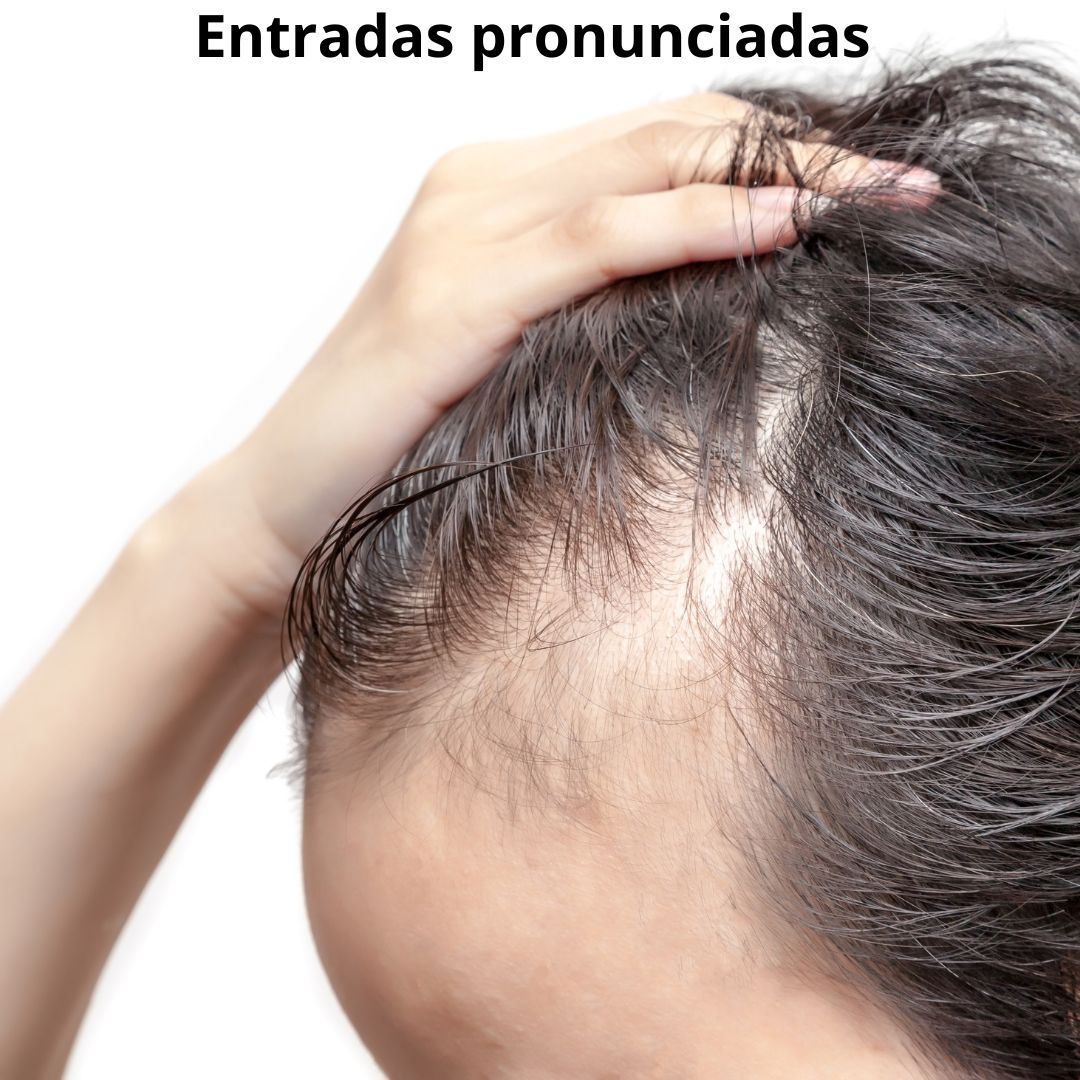 Minoxidil solución al 5%