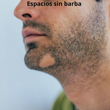 Minoxidil solución al 5%