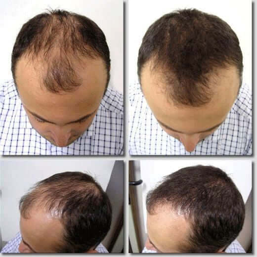 Minoxidil solución al 5%