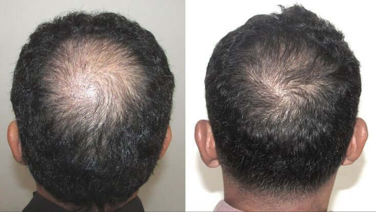 Minoxidil solución al 5%